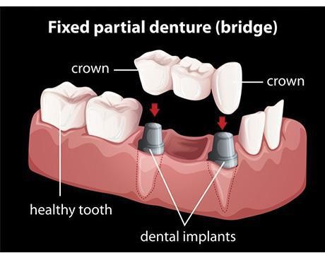 Permanent Dentures Cost Claunch NM 87011